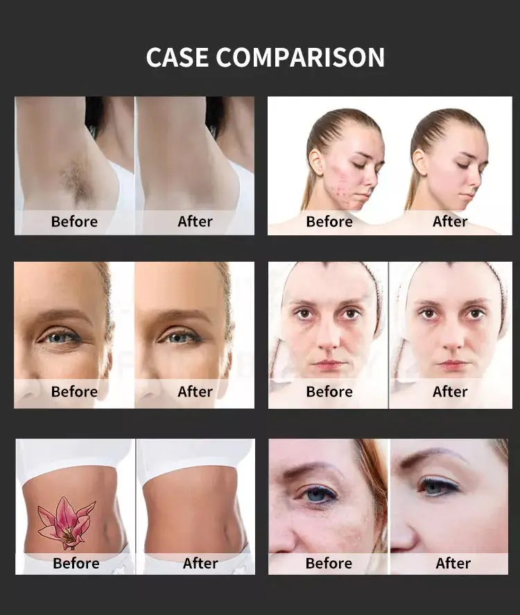 Multifunctional 2 in 1 Professional Beauty Equipment IPL OPT Hair Removal ND Yag Laser Tattoo Removal Pico Second Machine 2023