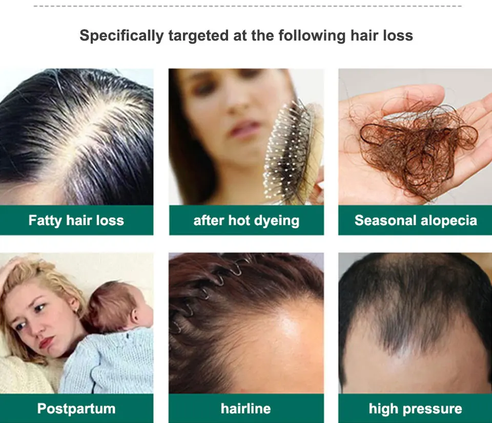 ZHANGGUANG 101 80ml Hair Shedding Proof Tonic Powerful Anti-Hair Loss Chinese Herbal Medicine Therapy Hair Loss Treatment Tonic