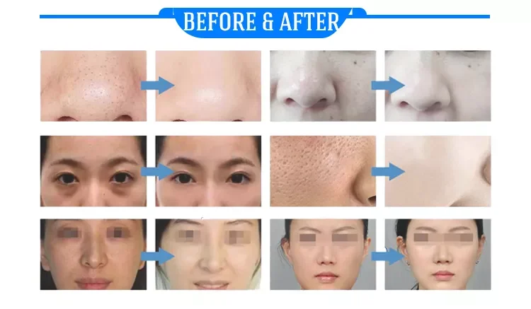 New Water Dermabrasion Oxygen Ice Blue Smart Jet Aqua Peel Small Bubble Skin Cleansing Device Facial Machine