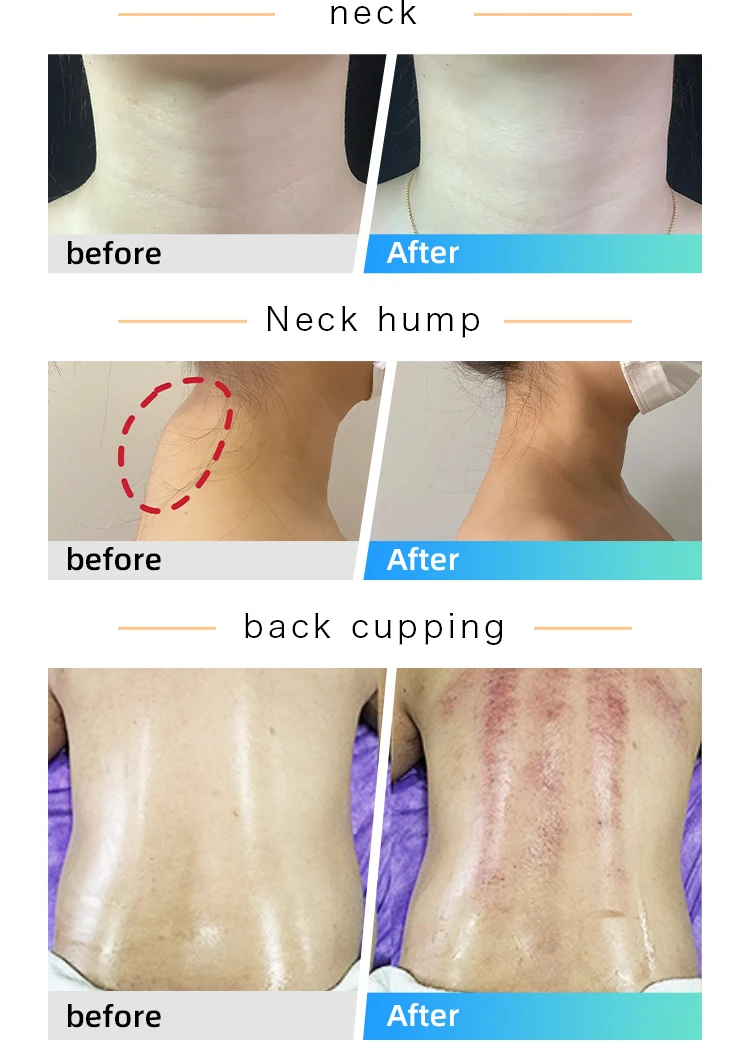 10 in 1 Body Sculpt Fast Weight Loss Cellulite Remover Body Sculpting 448k Cet Ret EMS Vacuum Cavitation Device