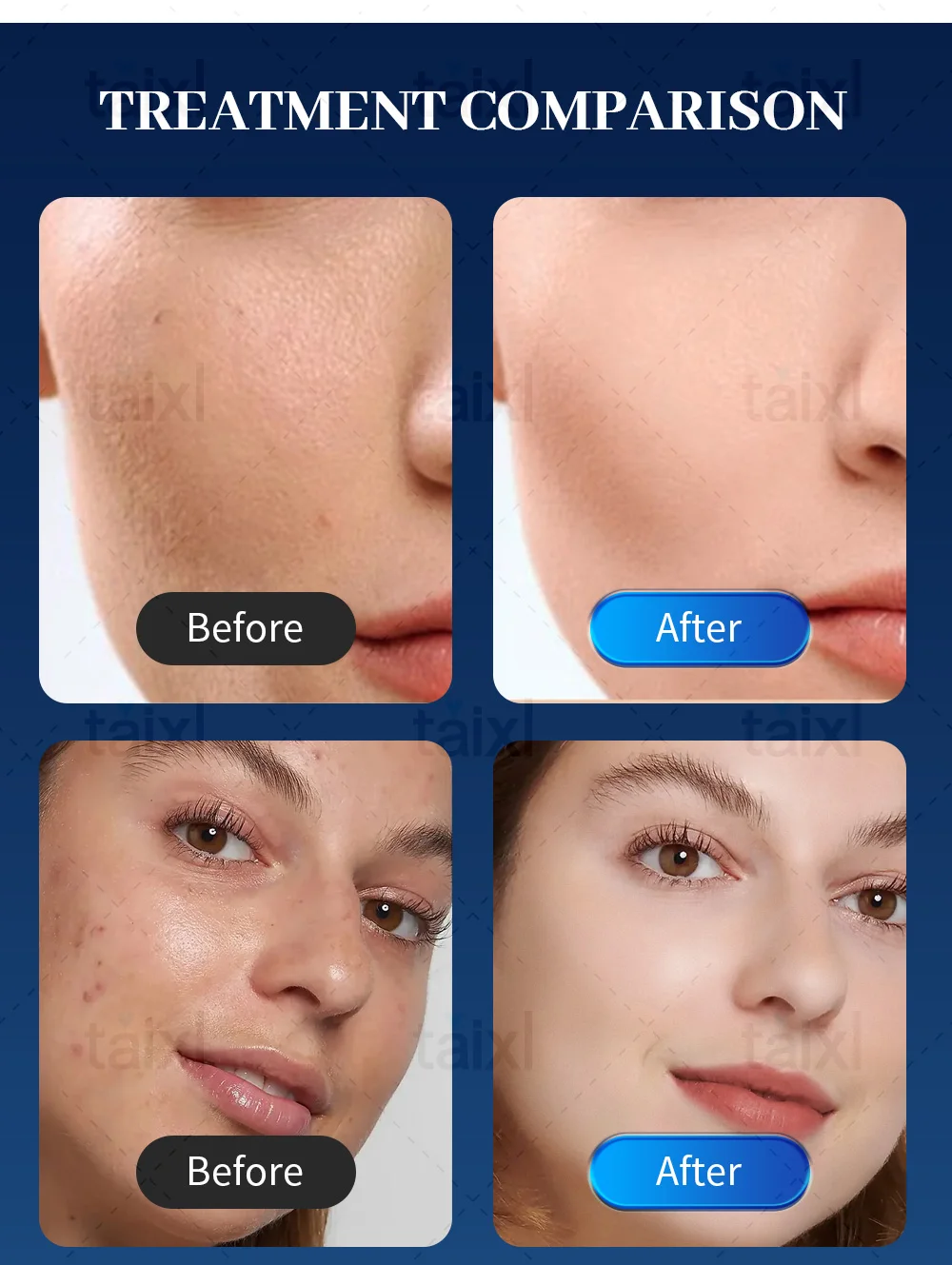 Facial Dermapen Radio Frequency Treatment Radio Frequency Collagen Regeneration Beauty Equipment Face Plug Skin Tightening