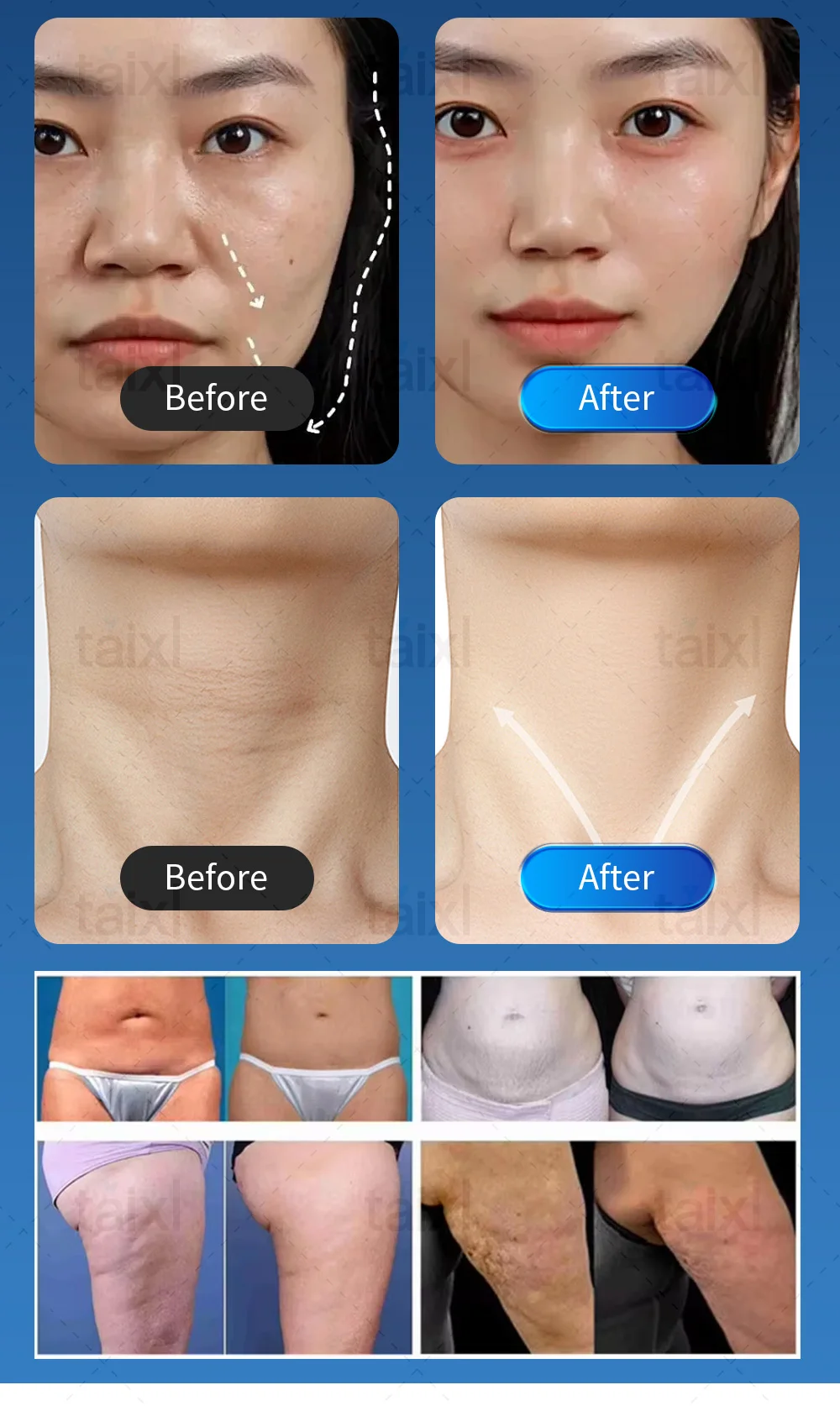 Facial Dermapen Radio Frequency Treatment Radio Frequency Collagen Regeneration Beauty Equipment Face Plug Skin Tightening