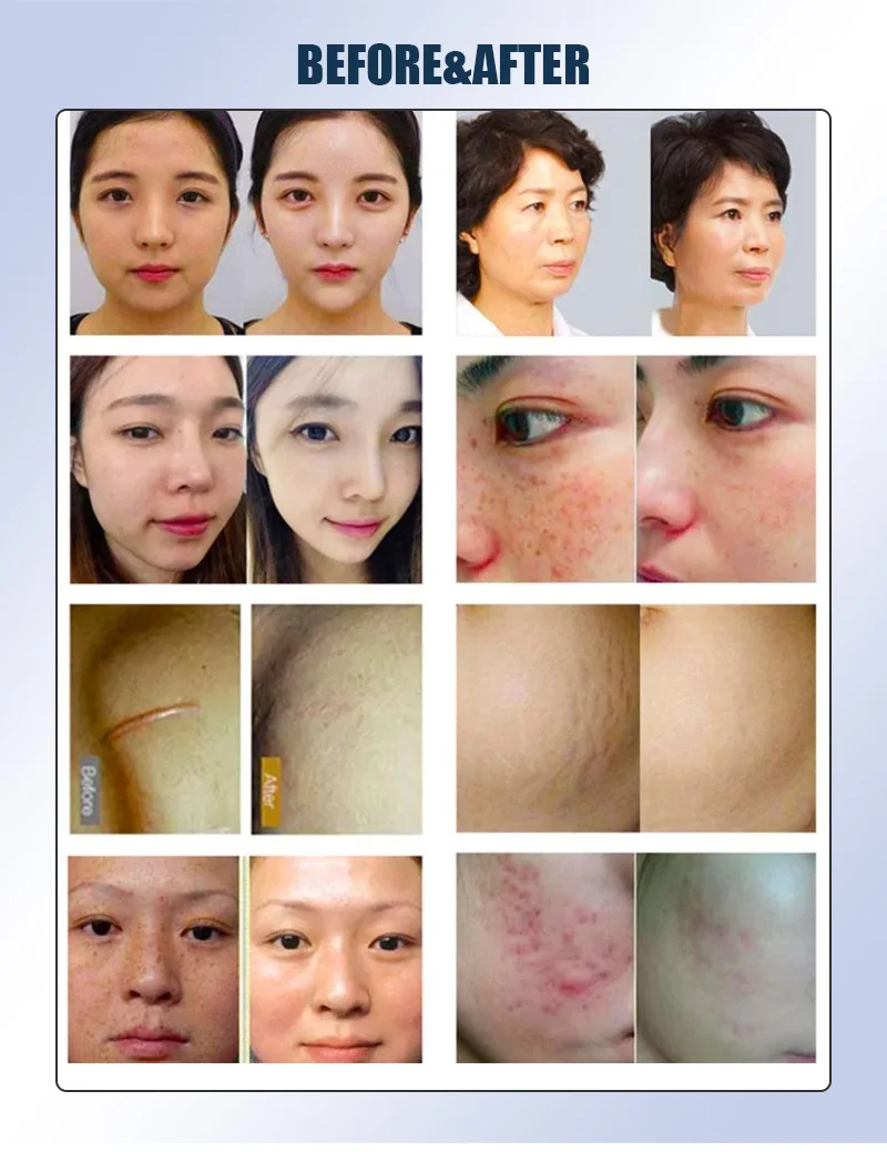 Gold Fractional Morpheus 8 Facial Body Rf Microneedling Catridges 64 Pins Inmode Radiofrecuent Morpheus8 Mchine