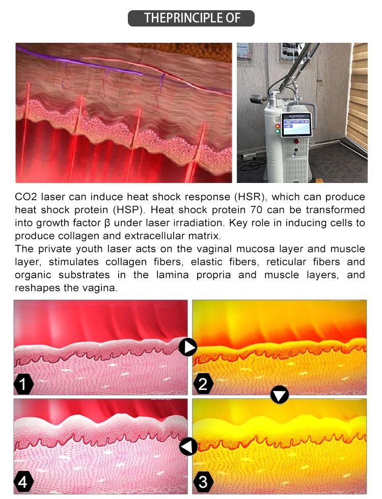 Newest Design 4D Fotona Co2 Fractional Lase Treatment Machine 10600nm Lase Beaut Machine For Resuacing Acne Scars