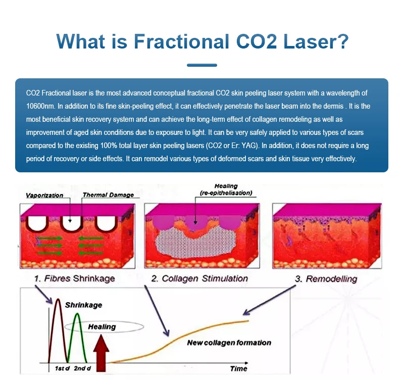 Newest Design 4D Fotona Co2 Fractional Lase Treatment Machine 10600nm Lase Beaut Machine For Resuacing Acne Scars