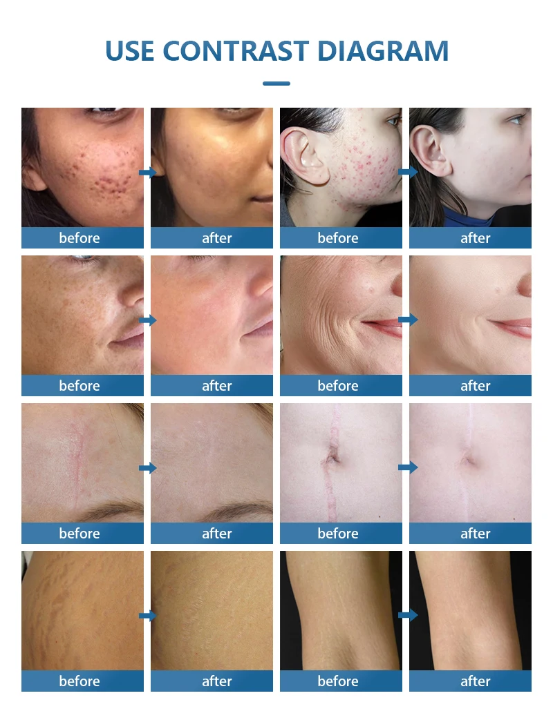 Newest Design 4D Fotona Co2 Fractional Lase Treatment Machine 10600nm Lase Beaut Machine For Resuacing Acne Scars