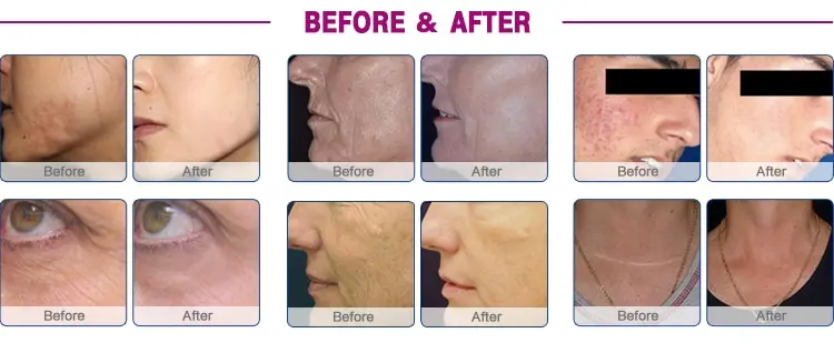2026new Portable Painless Co2 Fractional Laser Scar Removal Machine for Skin Rejuvenation Wrinkle Remover and Pigment Remove