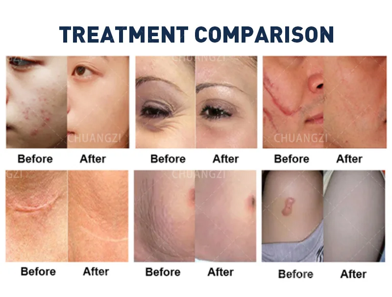 2026new Portable Painless Co2 Fractional Laser Scar Removal Machine for Skin Rejuvenation Wrinkle Remover and Pigment Remove