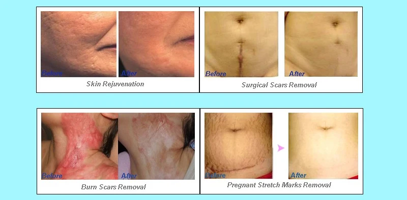 2026new Portable Painless Co2 Fractional Laser Scar Removal Machine for Skin Rejuvenation Wrinkle Remover and Pigment Remove