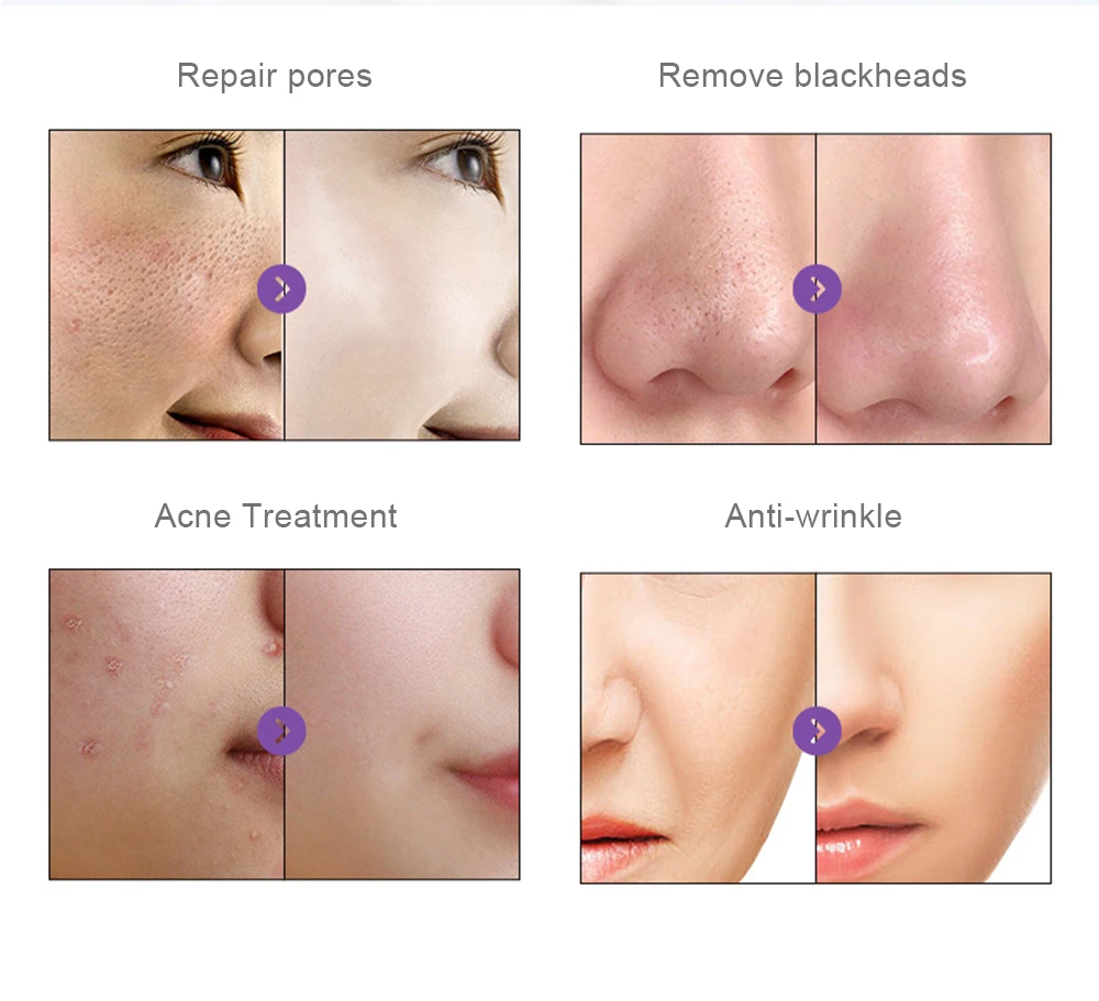 AOKO 7 in 1 H2O2 Hydro Dermabrasion Facial Machine Water Oxygen Skin Cleaning Lifting Professional Aqua Peeling Beauty Device