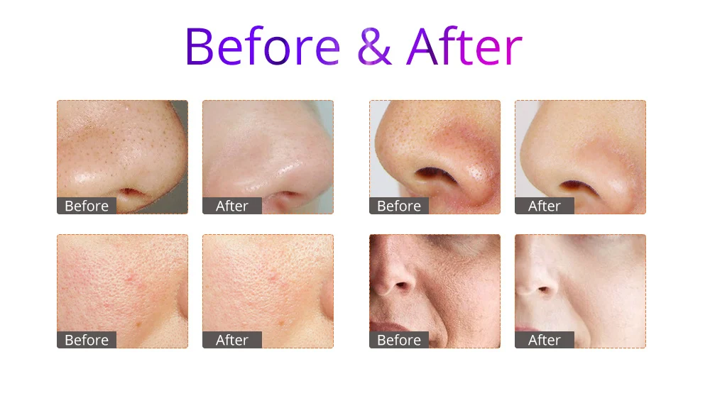 Hydro Ultrasonic Blackhead Removal Skin Scrubber Face Skin Deep Clean Machine Anti Acne Beauty Device