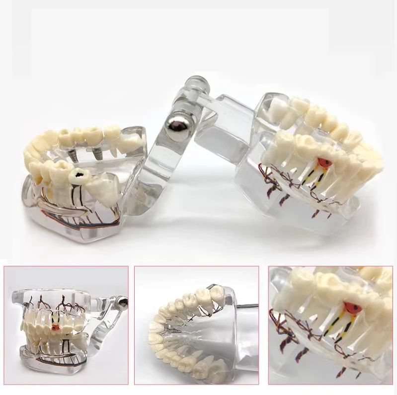 AG Teeth Neural Repair Dental Implant Pathological Model Dentist Students Communication Learning Research Oral Disease Teaching