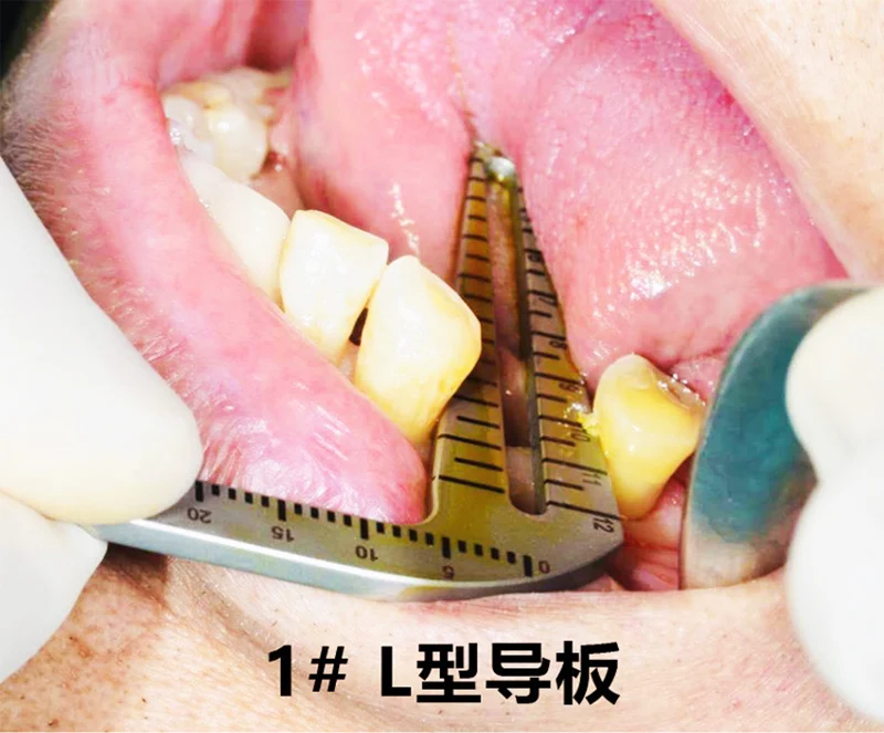 Dental Implant Guide Set Oral Planting Locator Positioning Guide Drilling Positioning Ruler Angle Ruler Implant Tools Dentist