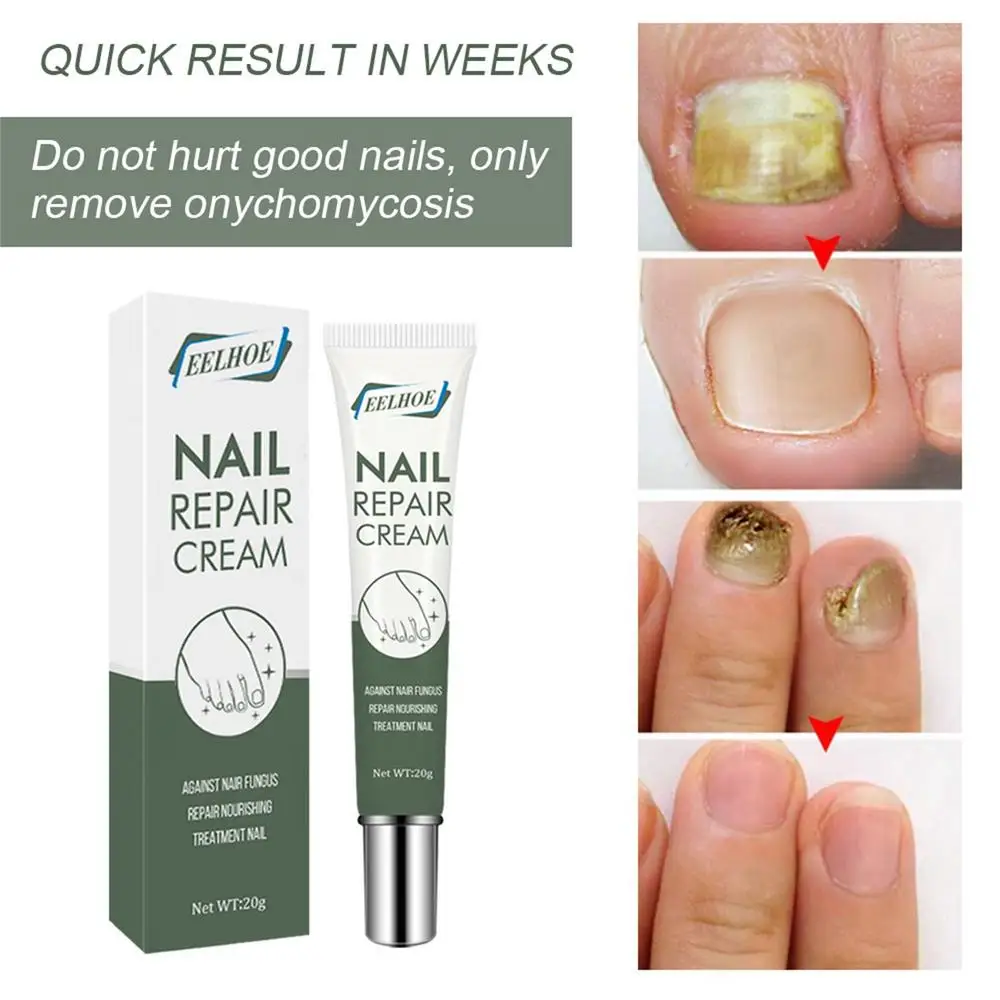 25g Nail Care Cream Anti-fungals Nail Therapy Serum Foot Nail Fungi Removal Gel Anti Infected Paronychia Onychomycosis Product