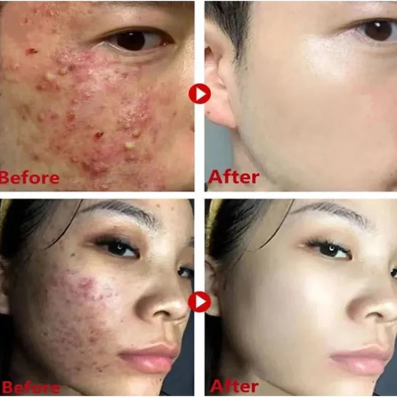 Alaska Volcano Mask Mugwort Cleansing Mask Stick Shrink Pores Acne Deep Blackhead Remover Facial Cleansing Moisturizing Mask 40g