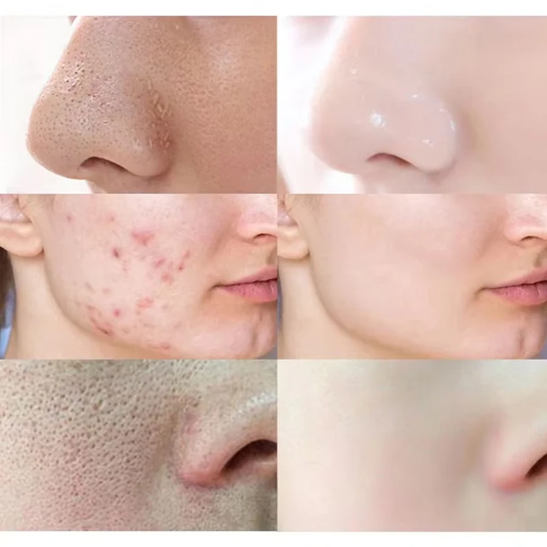 Alaska Volcano Mask Mugwort Cleansing Mask Stick Shrink Pores Acne Deep Blackhead Remover Facial Cleansing Moisturizing Mask 40g