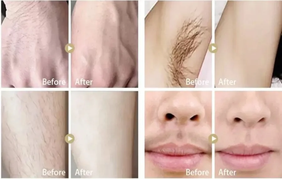 Portable 808 3wave Diode Permanent Hair Remove Fast Depilation Painfree Follicle Penetration Skin Rejuvenation Device