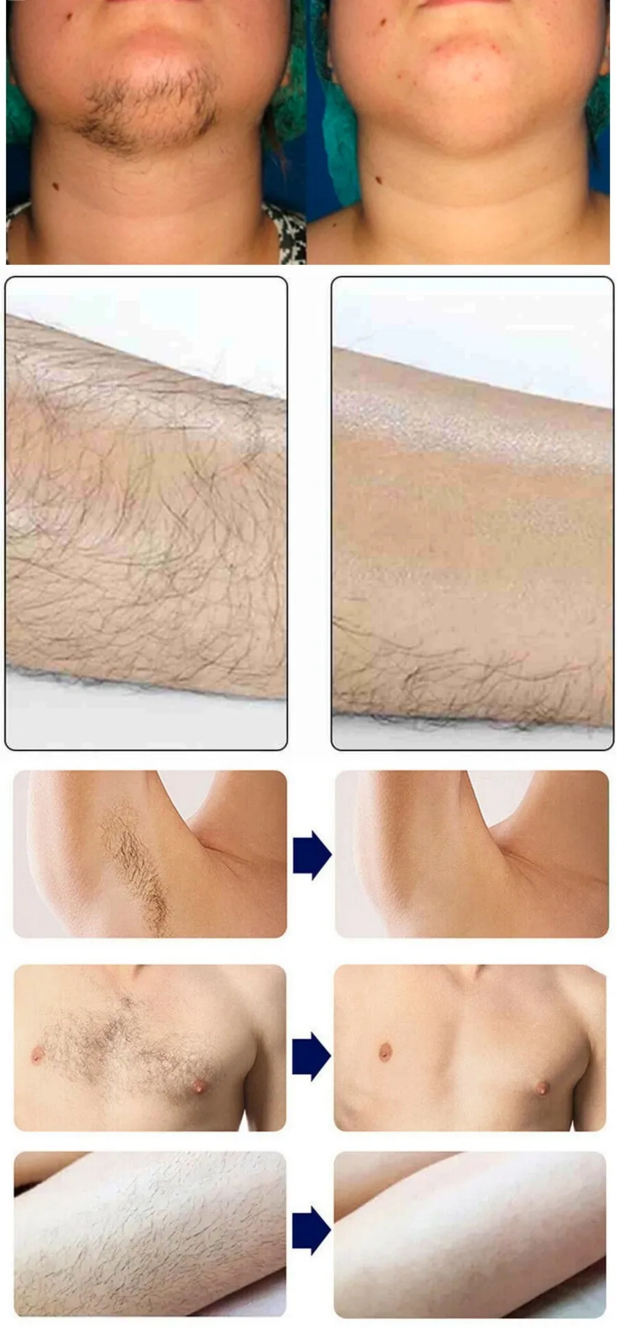 Portable 808 3wave Diode Permanent Hair Remove Fast Depilation Painfree Follicle Penetration Skin Rejuvenation Device