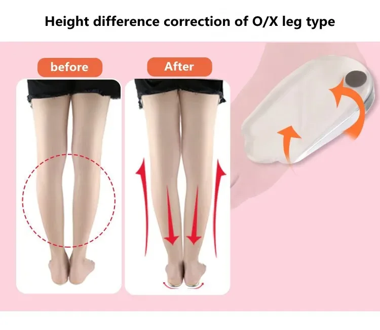 Orthopedic Gel Insoles Magnet Massage Foot Care Silicone O/X Leg Type Valgus Varus Correction for Plantar Fasciitis Shoe Inserts