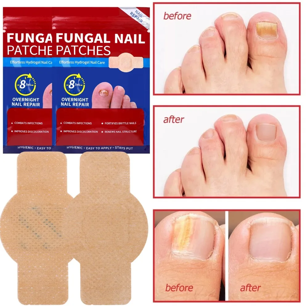 Nail Repair Patches Toenail Fungus Patch Sticky Toenail Care Nail Ingrown Correction Sticker Paronychia Disposable Toe Patch