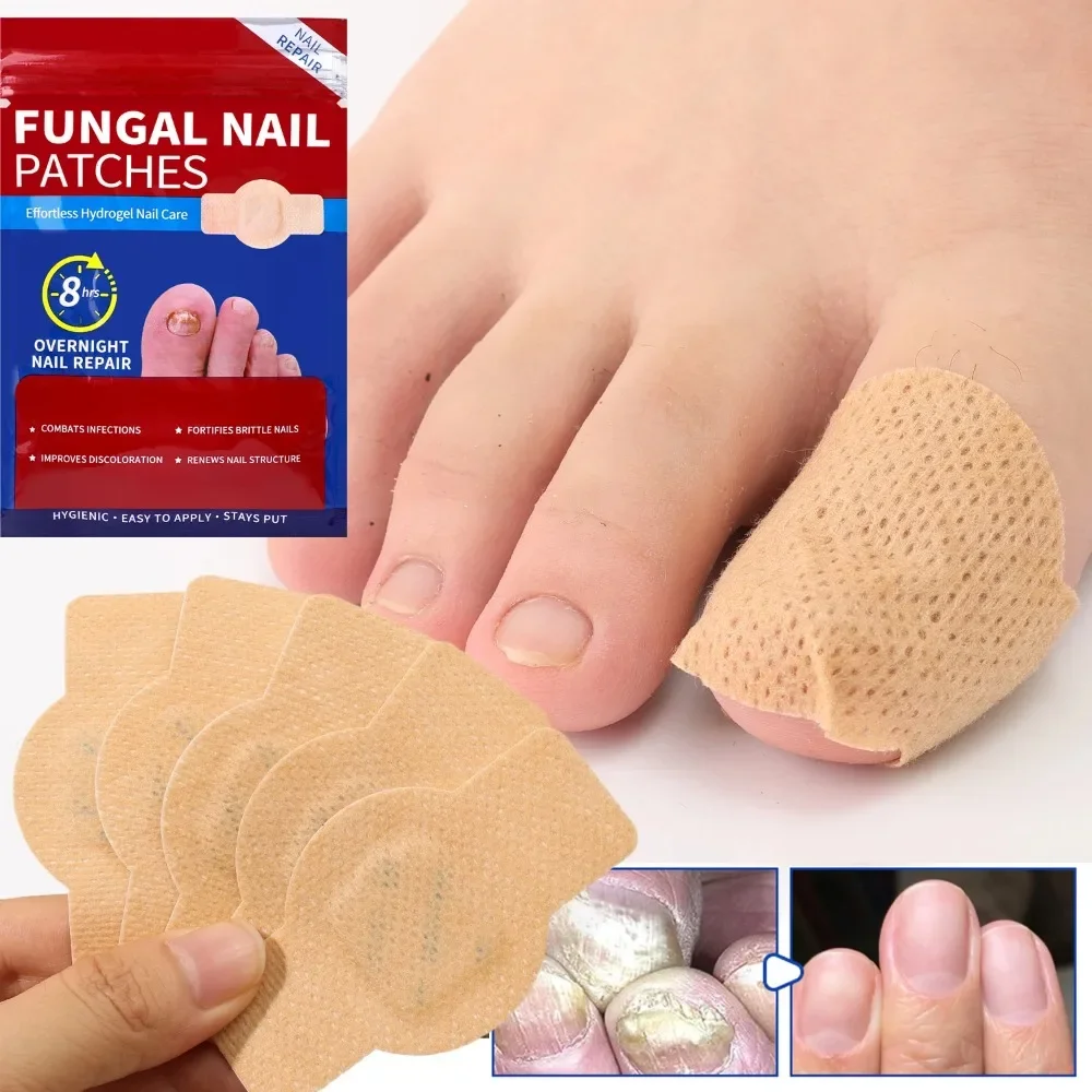 Nail Repair Patches Toenail Fungus Patch Sticky Toenail Care Nail Ingrown Correction Sticker Paronychia Disposable Toe Patch