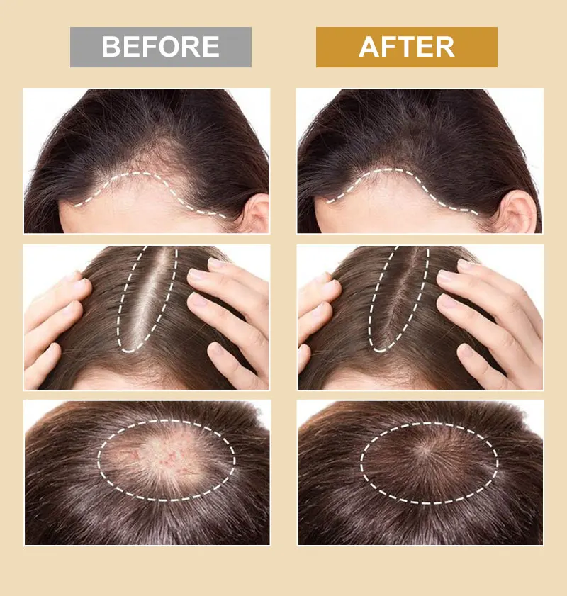PURC Biotin Hair Growth Oil for Men Women Hair Loss Treatment Fast Grow Hair Spray Regrowth Thicken Oil Hair Care Products