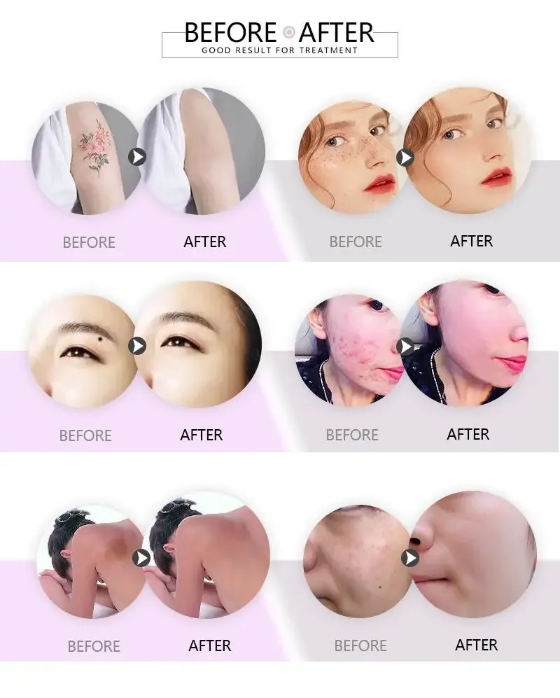 Picosecond 532nm 755nm 1064nm Tattoo Removal Remove Freckle White New Pico Lase Tattoo Removal Portable