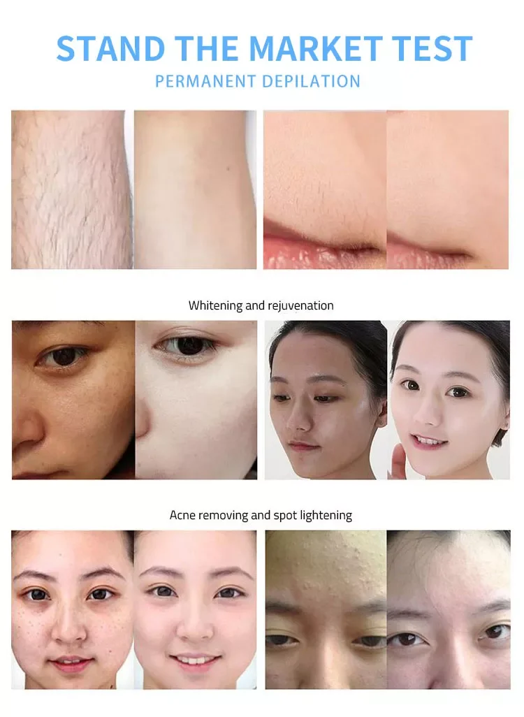 Factory Direct Sales M22 Photon Skin Rejuvenation OPT IPL Vascular Acne Removal Nd Yag Tattoo Remove Hair Removal Machine