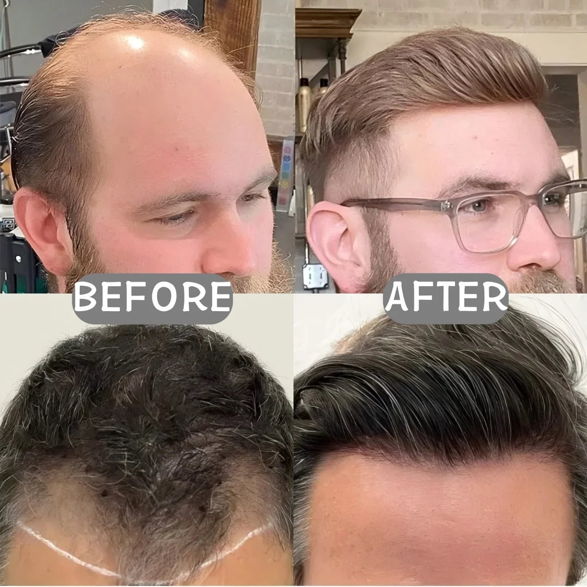 Men's Forehead Hairline Wig High Density Human Hair Skin PU Men's Frontal Hairpiece V Ring Frontal Hair Top